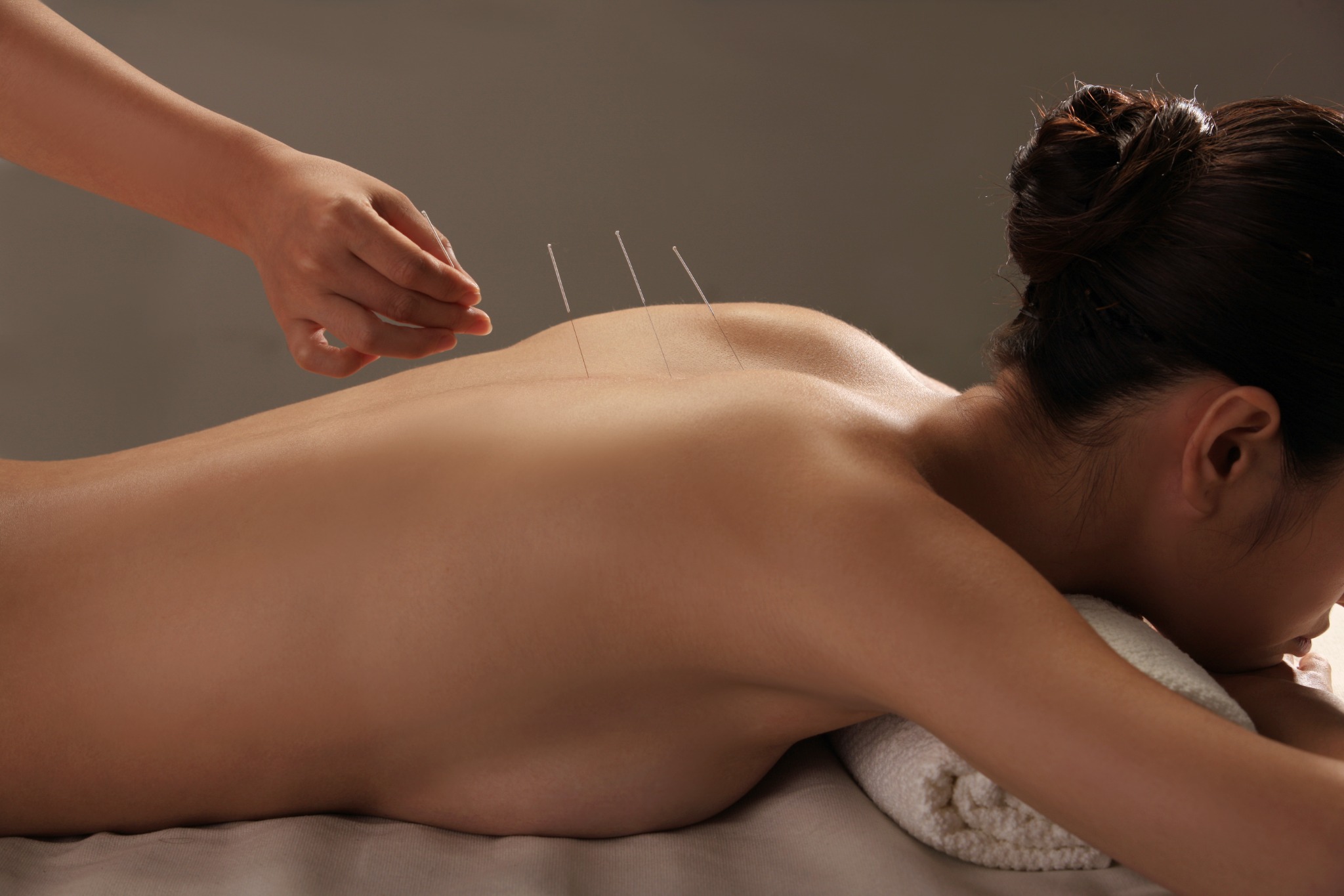 Acupunctuurbehandeling met naalden op de rug